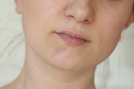 Neben meinem linken Nasenflügel und am Kinn verfärben sich die behandelten Stellen sogleich lila.