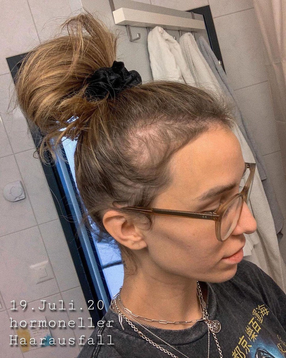 Swiss influencer Anja Zeidler showed off her hair loss and newly regrown hair six months after the birth of her daughter.