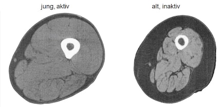 Immagini di risonanza magnetica della metà della coscia di un adulto sano di 25 anni (sinistra) e di un adulto sano di 75 anni (destra) che mostra sarcopenia. Da notare la minore massa muscolare (grigio chiaro), il maggiore grasso sottocutaneo (grigio scuro) e l'aumento del grasso intramuscolare (linee grigio scuro) nella gamba del partecipante più anziano. Adattato da [32].