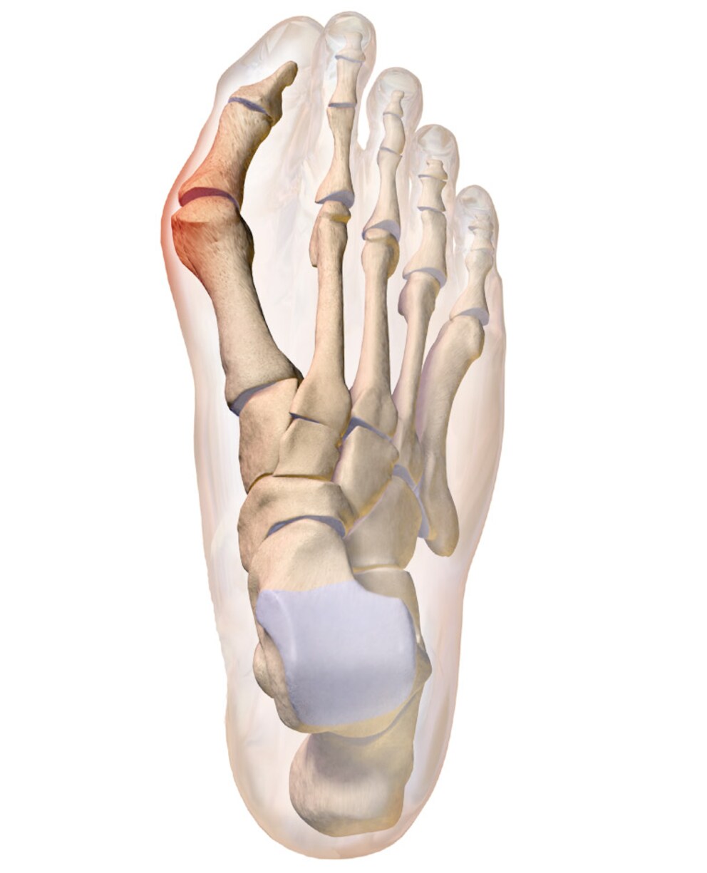 Der Hallux valgus ist eine Fehlstellung des ersten Mittelfussknochens.