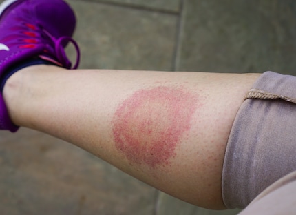If you notice redness after a tick sting, you should make seeing a doctor a priority.