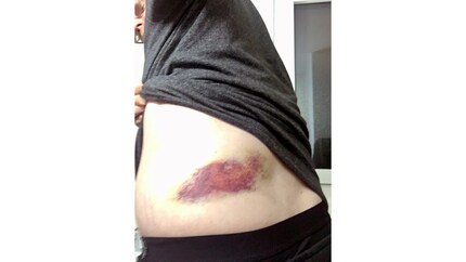 Sorry about the dodgy quality, but this is what my haematoma looked like a short while after I fell.