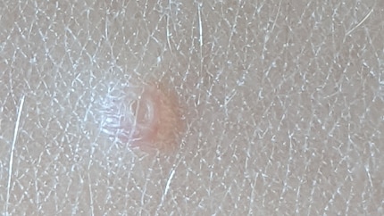 Eltern können Dellwarzen an dieser charakteristischen Delle bei Ihren Kleinen oft selbst erkennen.