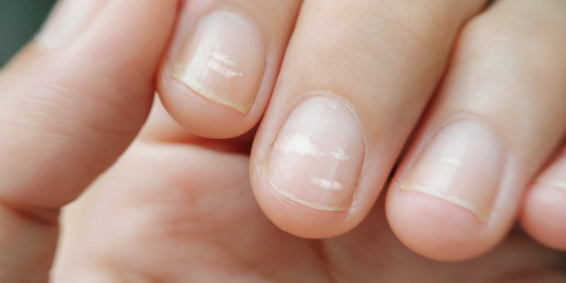 Test delle unghie: cosa rivelano le tue unghie sulla tua salute
