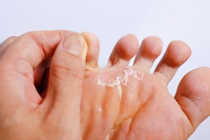 La mycose du pied est désagréable pour les personnes concernées, mais elle est relativement facile à traiter.