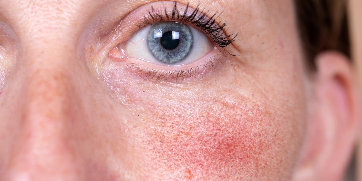 Taches rouges, pustules et nez bulbeux : traiter la rosacée à temps ...