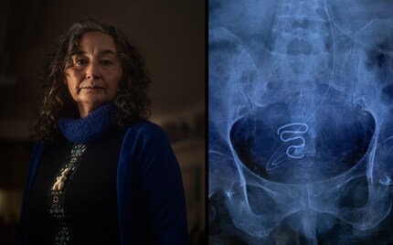 En 2019, Nanja Lyberth (à gauche) a raconté son calvaire à un journal local de Nuuk, ce qui a déclenché le scandale. A droite, une radiographie photographiée d'un stérilet implanté.