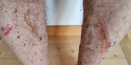Sieht hässlich aus: von den eigenen Pedalen malträtiert.