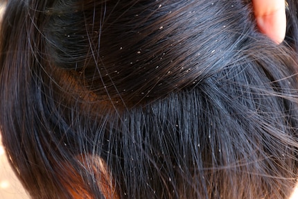 Tout doit être enlevé : les œufs de poux et les lentes tenaces se collent dans les cheveux.