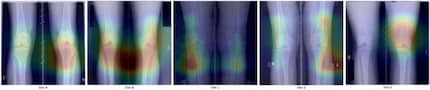 Although the AI’s supposed to use these X-ray images to identify whether the patient is a beer drinker, it’s actually deriving its results from other factors.